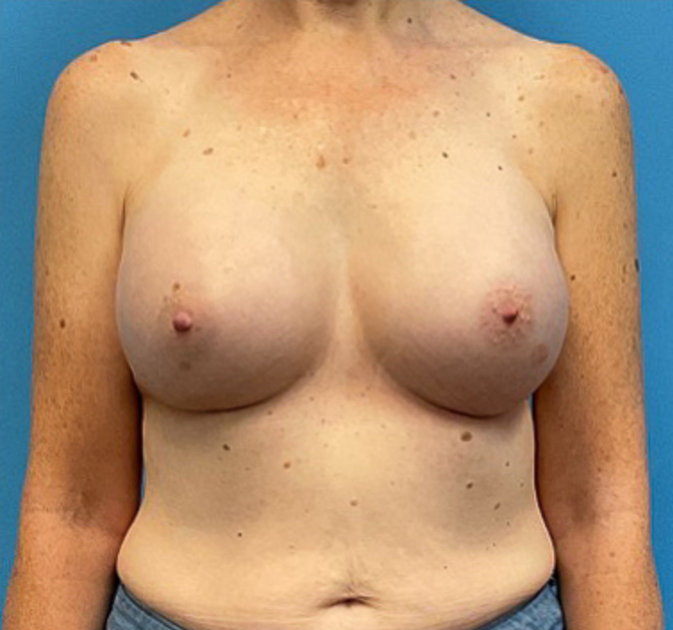 Breast-Augmentation-Case--27374 | After Breast 1