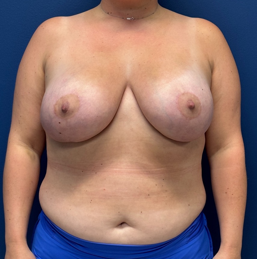 Breast-Augmentation-Mastopexy-Case--29079 | After Breast 1
