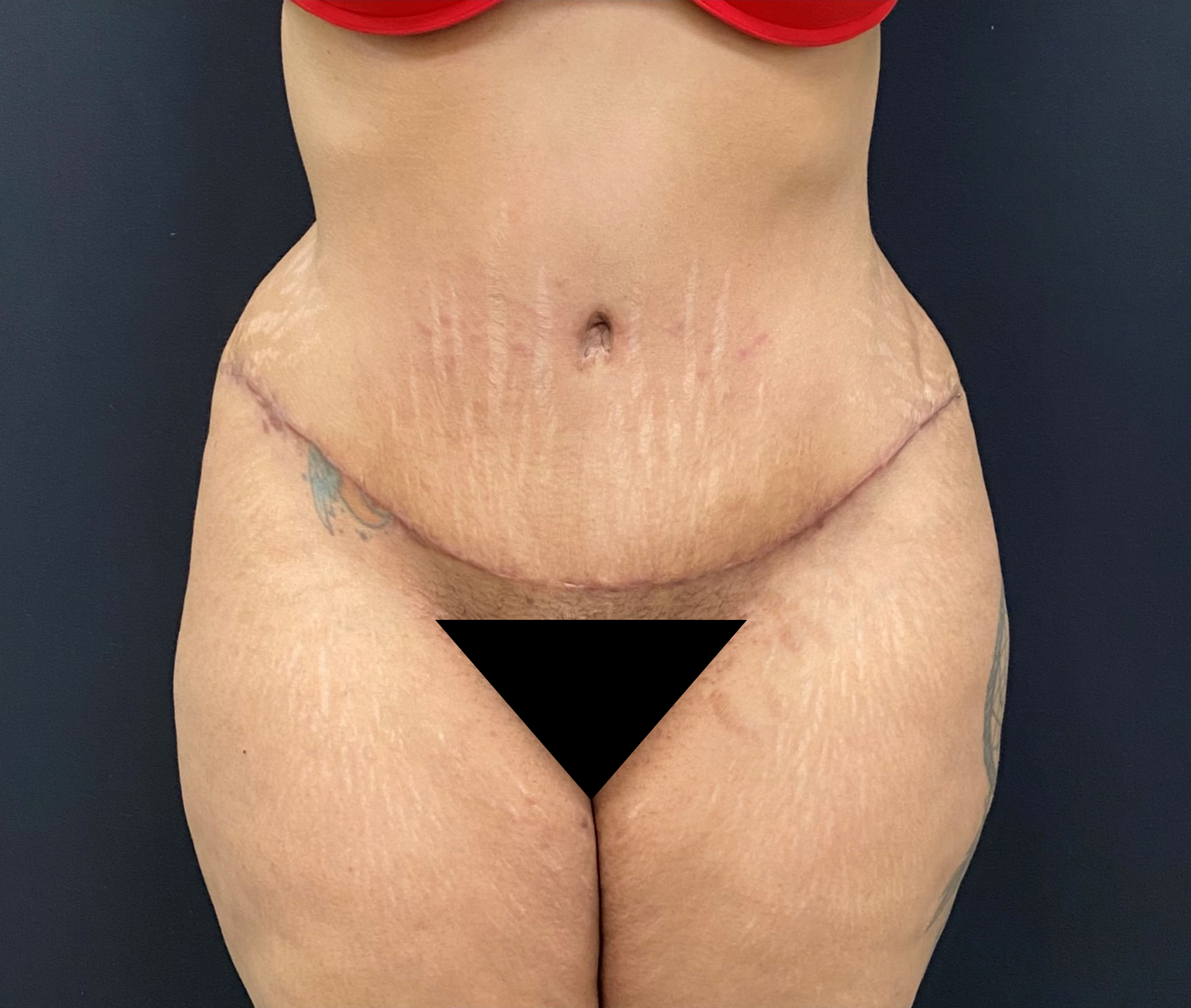 Liposuction-Tummy-Tuck-Case--338 | After Tummy Tuck 1