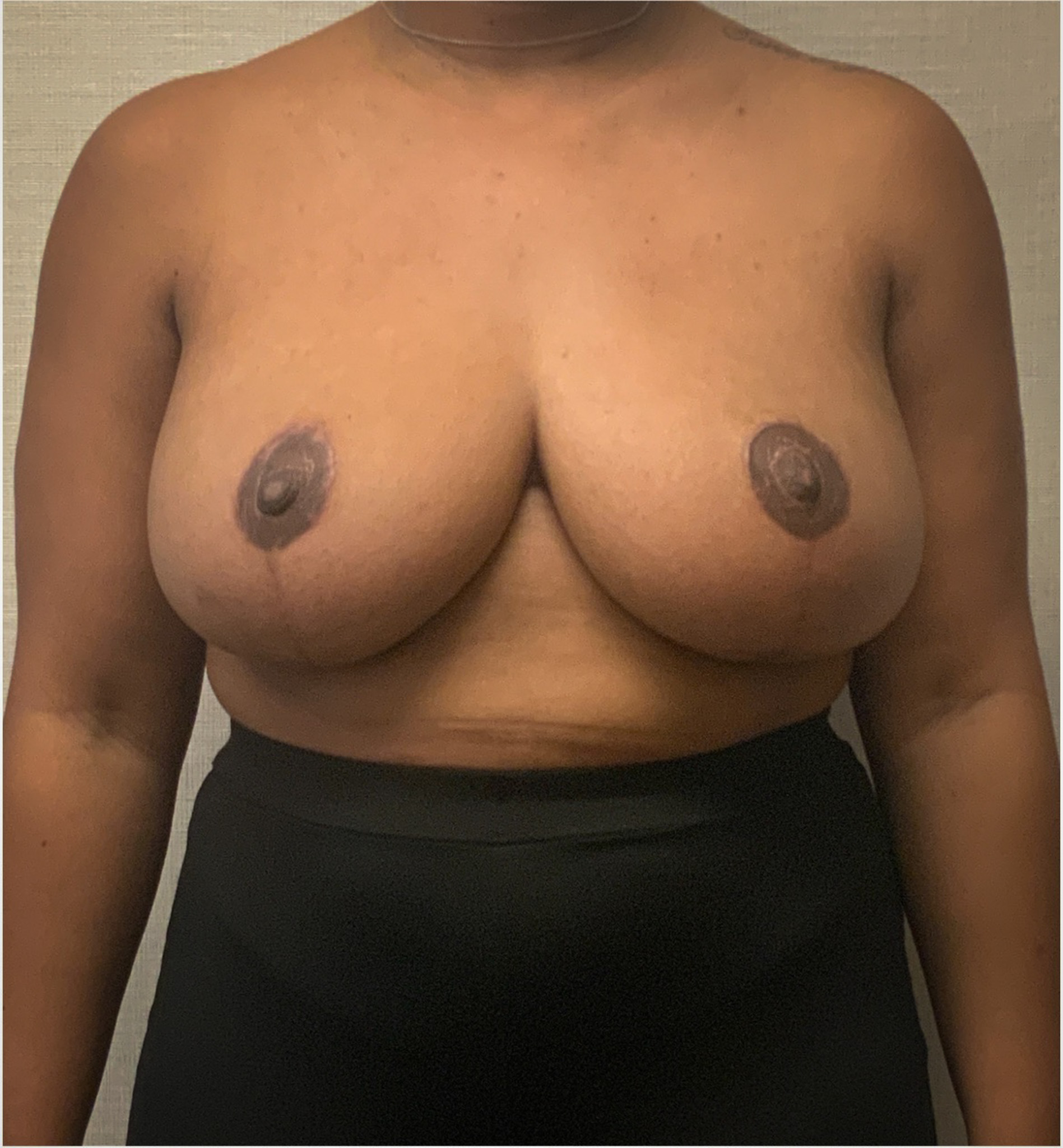Breast-Reduction-Case--2564 | After Breast 1