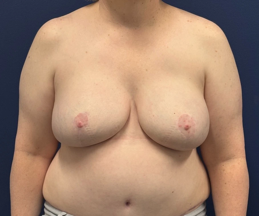 Breast-Reconstruction-DIEP-Flap-Case--26029 | After Breast 1