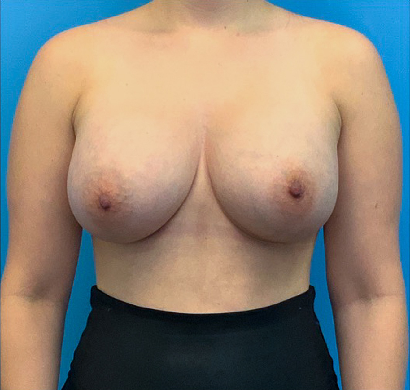 Breast-Augmentation-Case--23631 | After Breast 1
