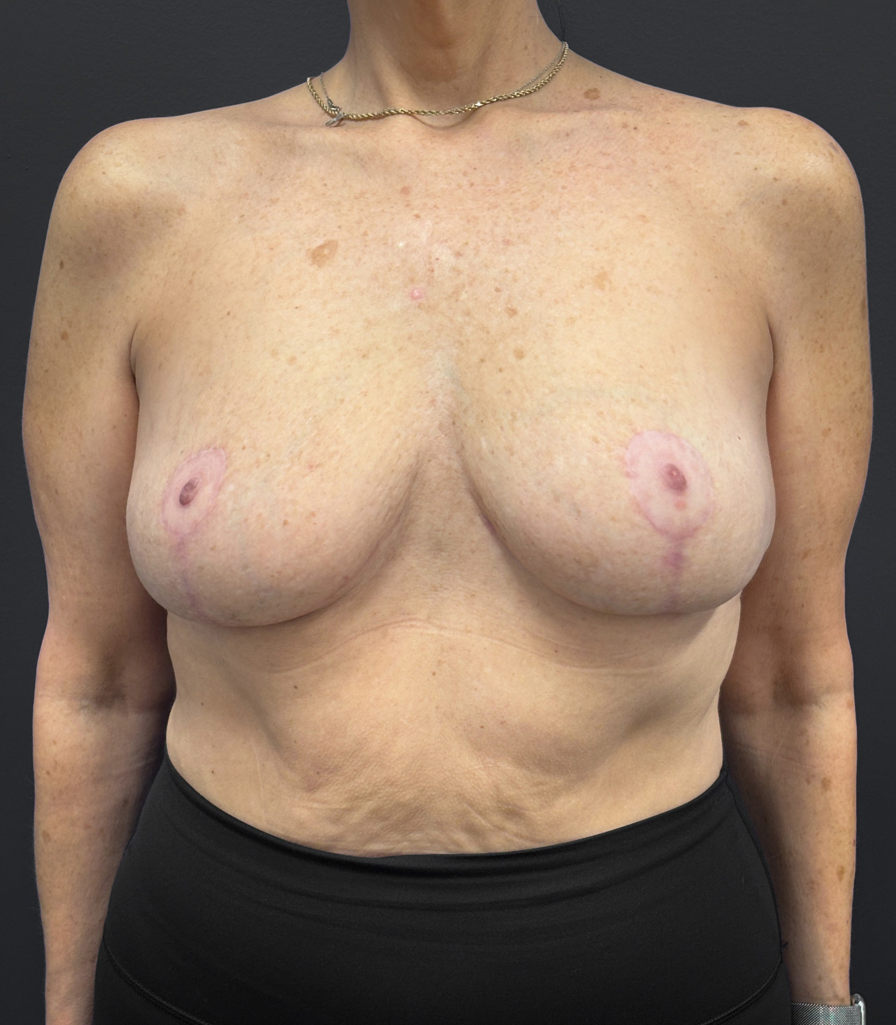 Breast-Reduction-Case--2538 | After Breast 1