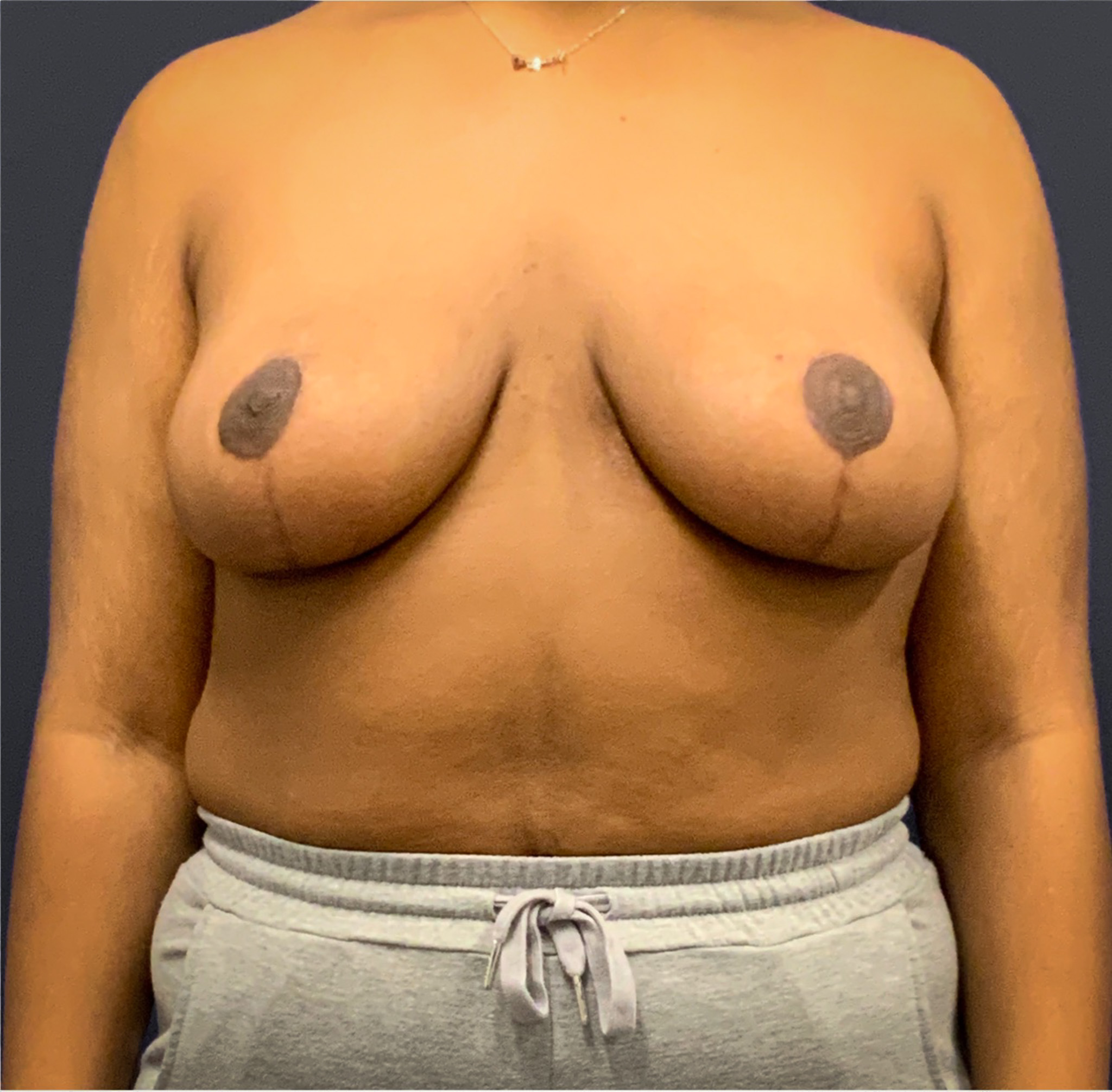 Breast-Reduction-Case--5320 | After Breast 1