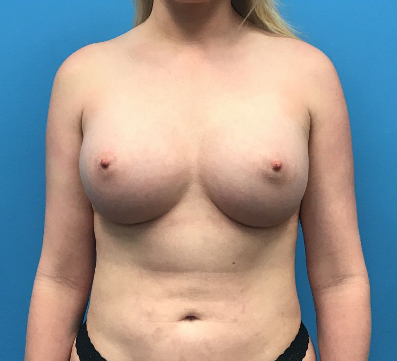 Breast-Augmentation-Case--219 | After Breast 1