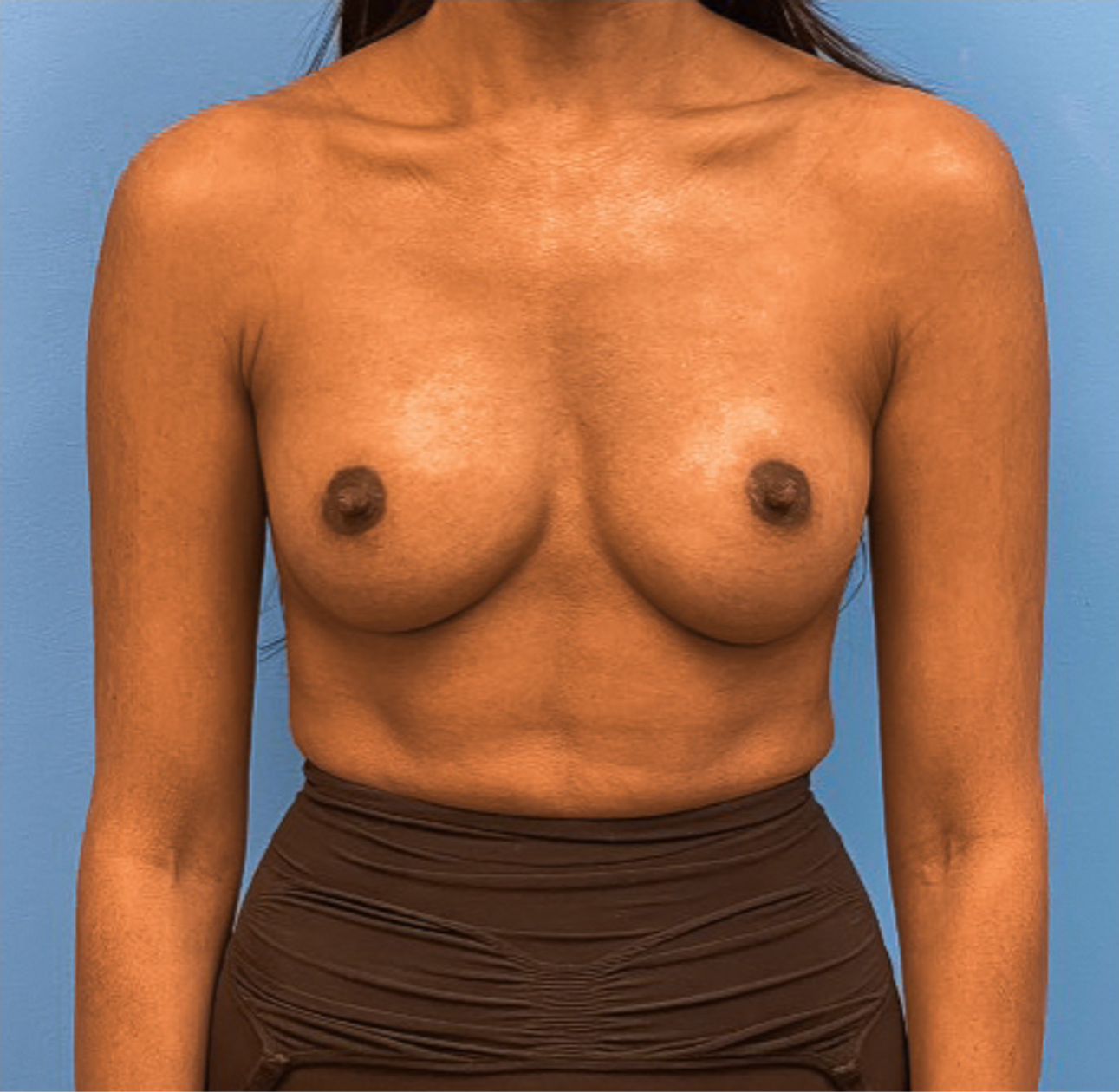 Breast-Augmentation-Case--25592 | After Breast 1
