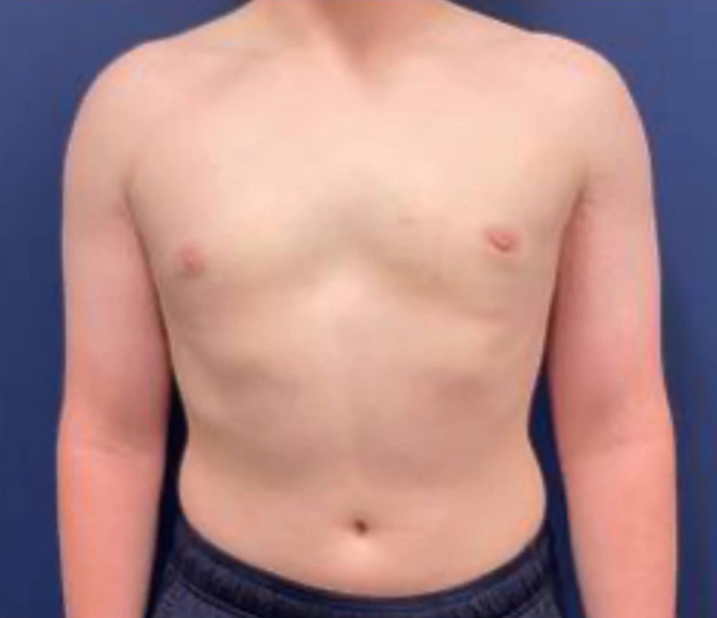 Gynecomastia-Case--214 | After Breast 1