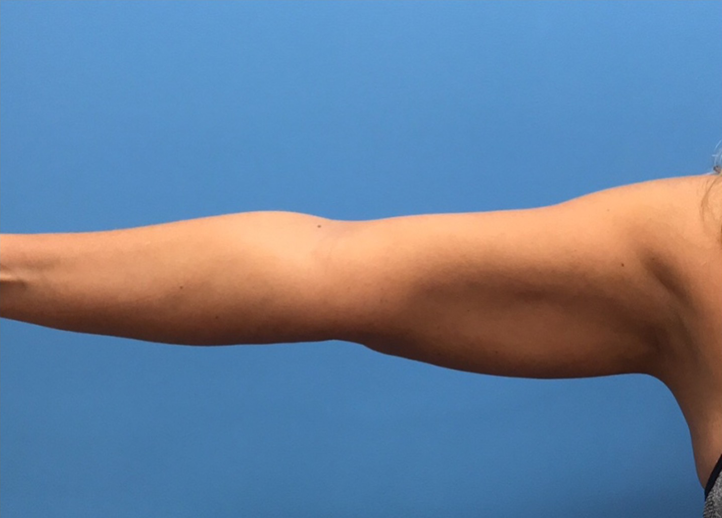 Case--280 | After Liposuction 1