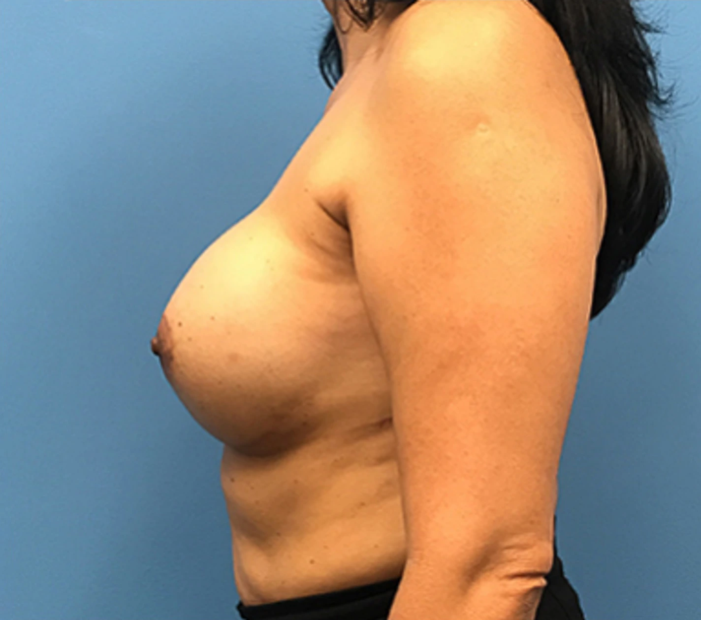 Case--134 | After Breast 2