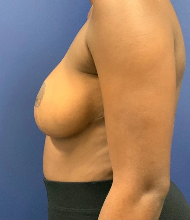 Breast-Reduction-Case--27254 | After Breast 2