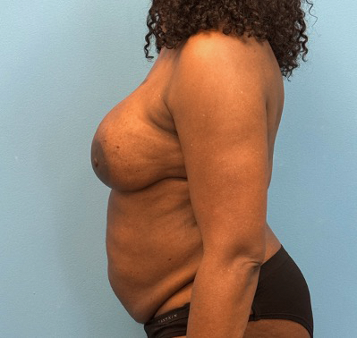 Breast-Reconstruction-Case--23930 | After Breast 2