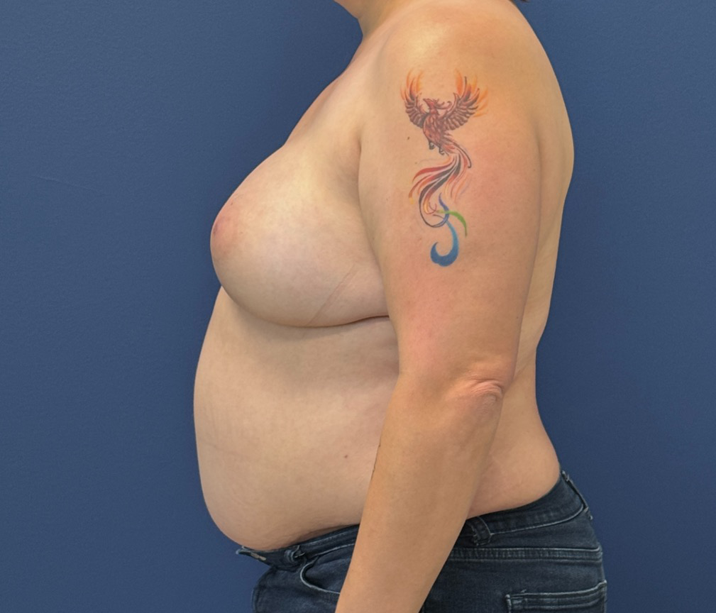 DIEP-Flap-Case--28021 | After Breast 2
