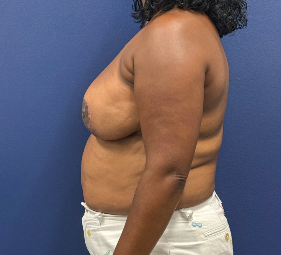 Breast-Reduction-Case--28242 | After Breast 2