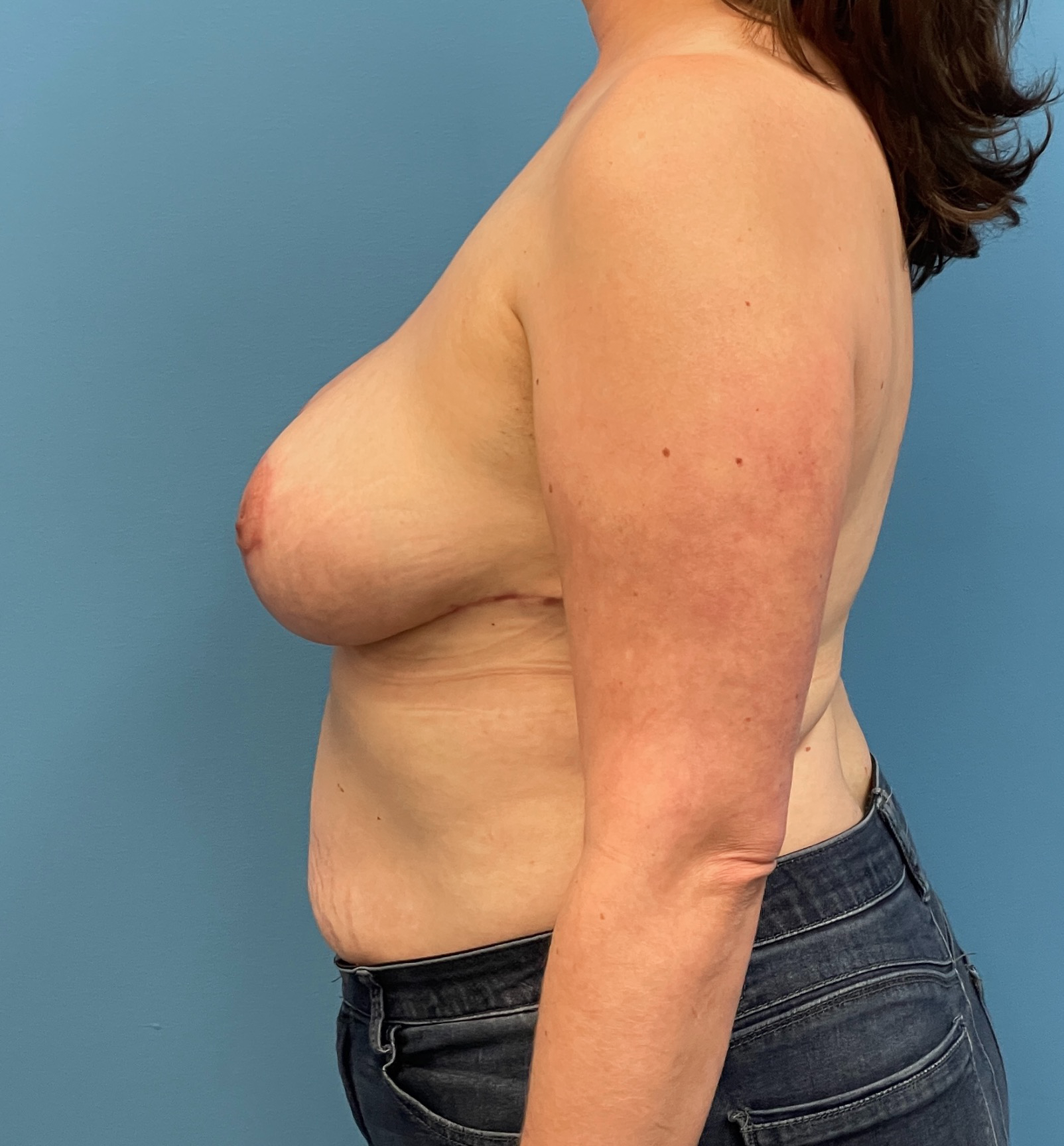 Breast-Reduction-Case--27625 | After Breast 2
