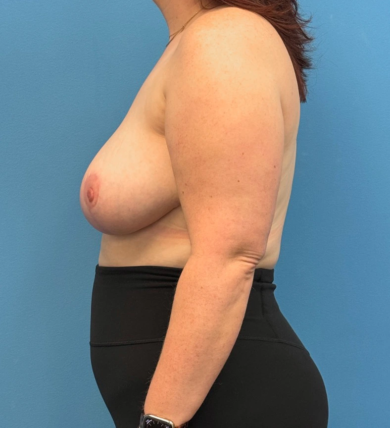 Breast-Reduction-Case--28338 | After Breast 2