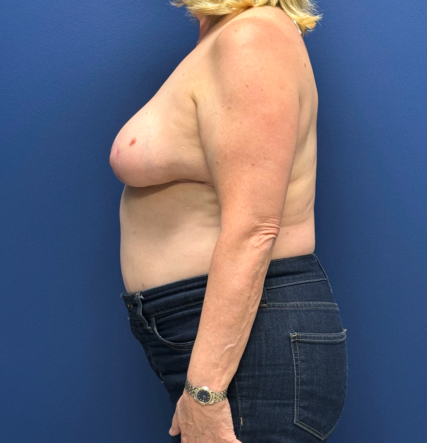 Breast-Reduction-Case--29091 | After Breast 2