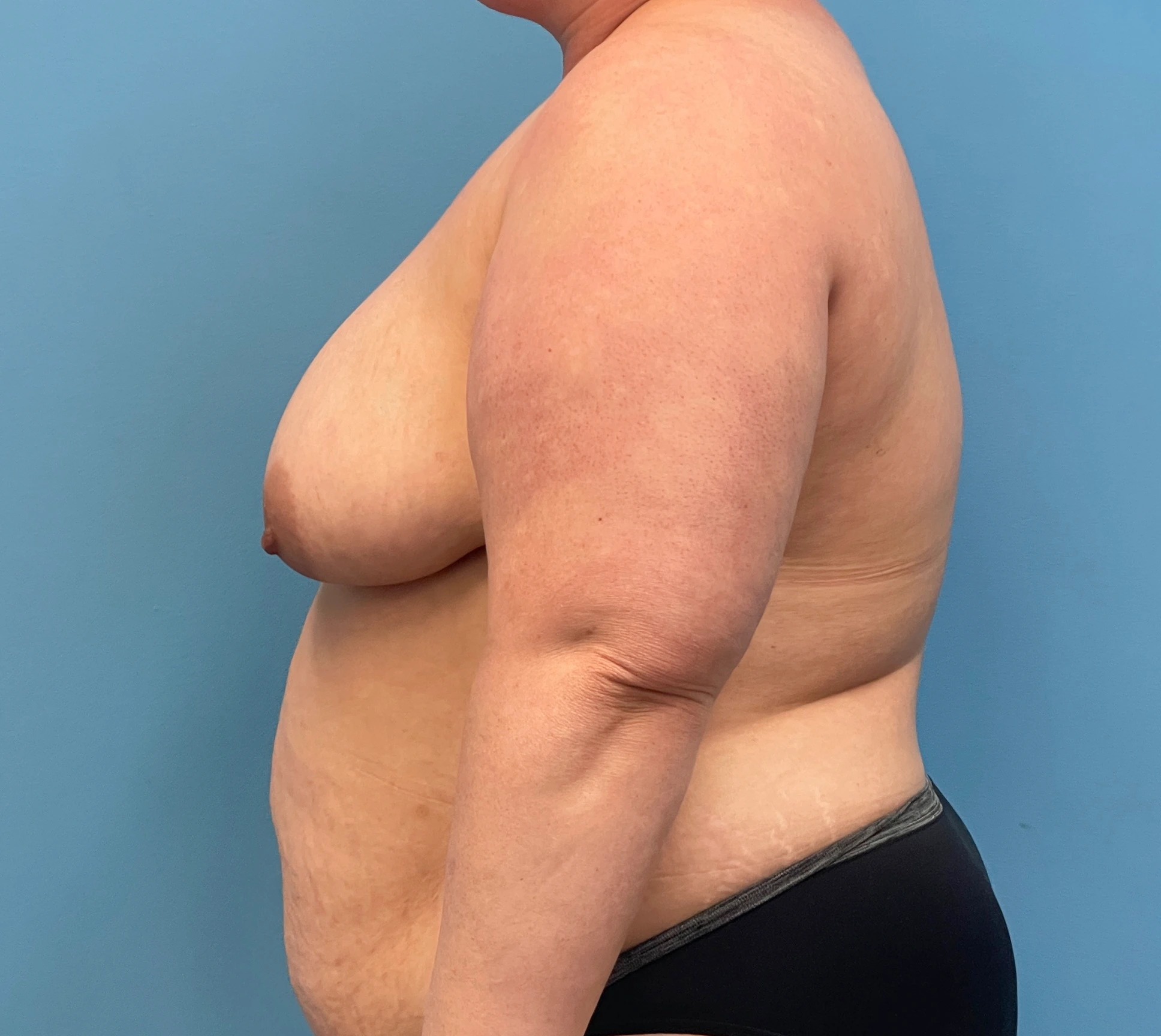 DIEP-Flap-Case--27595 | Before Breast 2