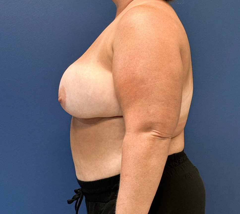 DIEP-Flap-Case--27595 | After Breast 2