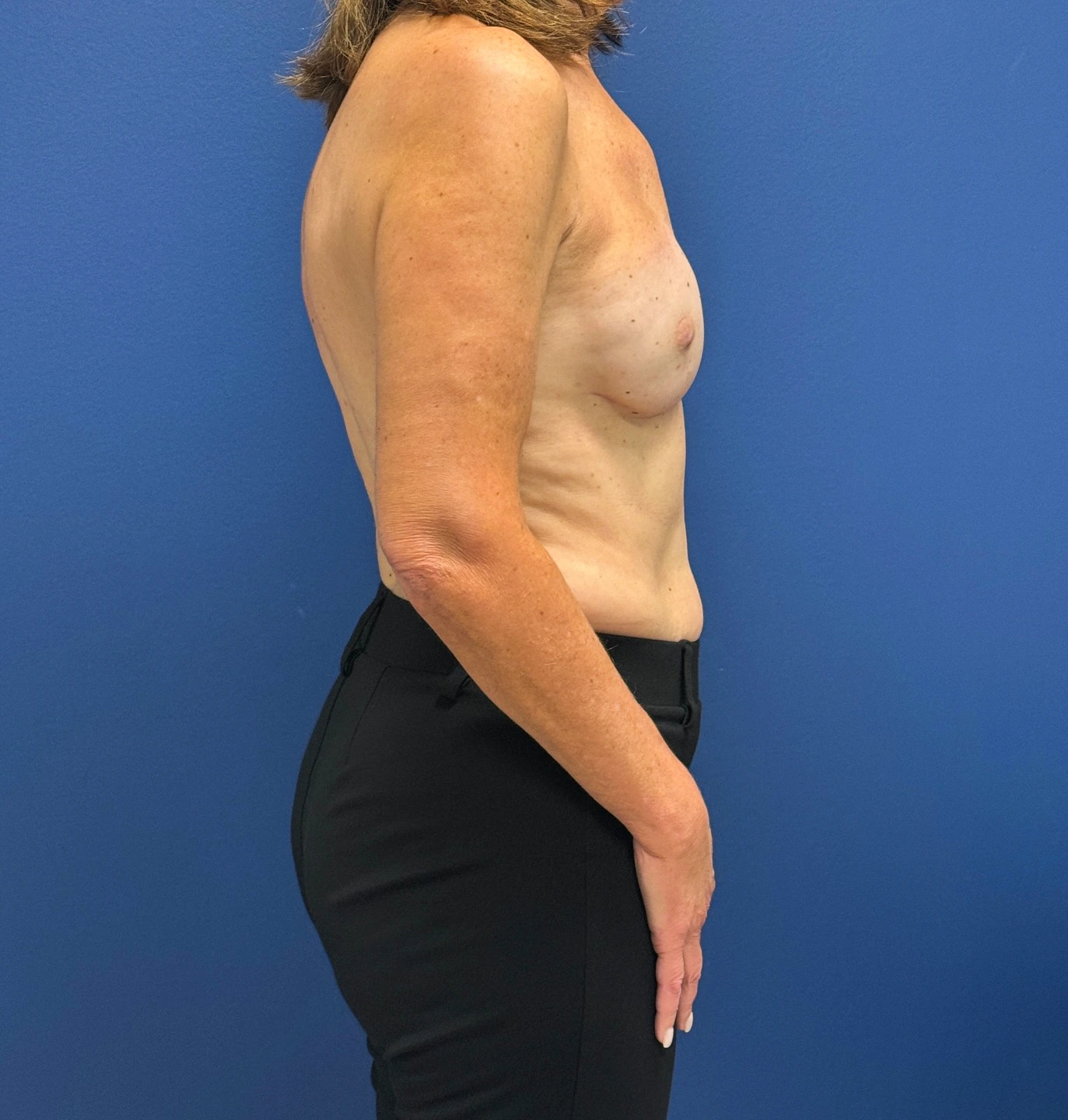 Breast-Reconstruction-Case--28688 | After Breast 2