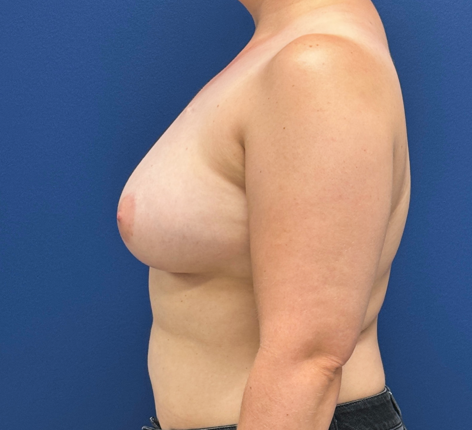 Breast-Reconstruction-Case--28689 | After Breast 2