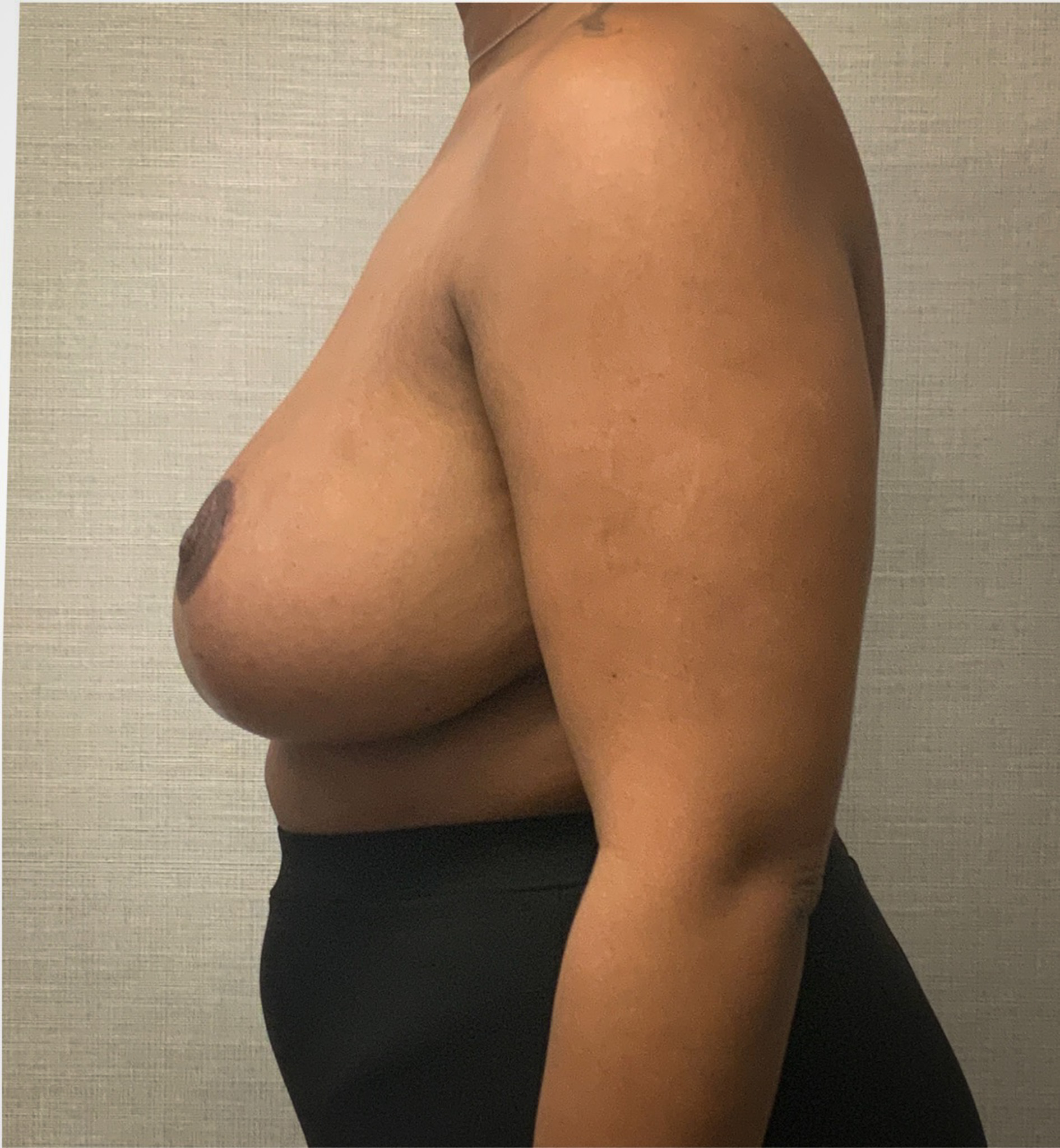 Breast-Reduction-Case--2564 | After Breast 2