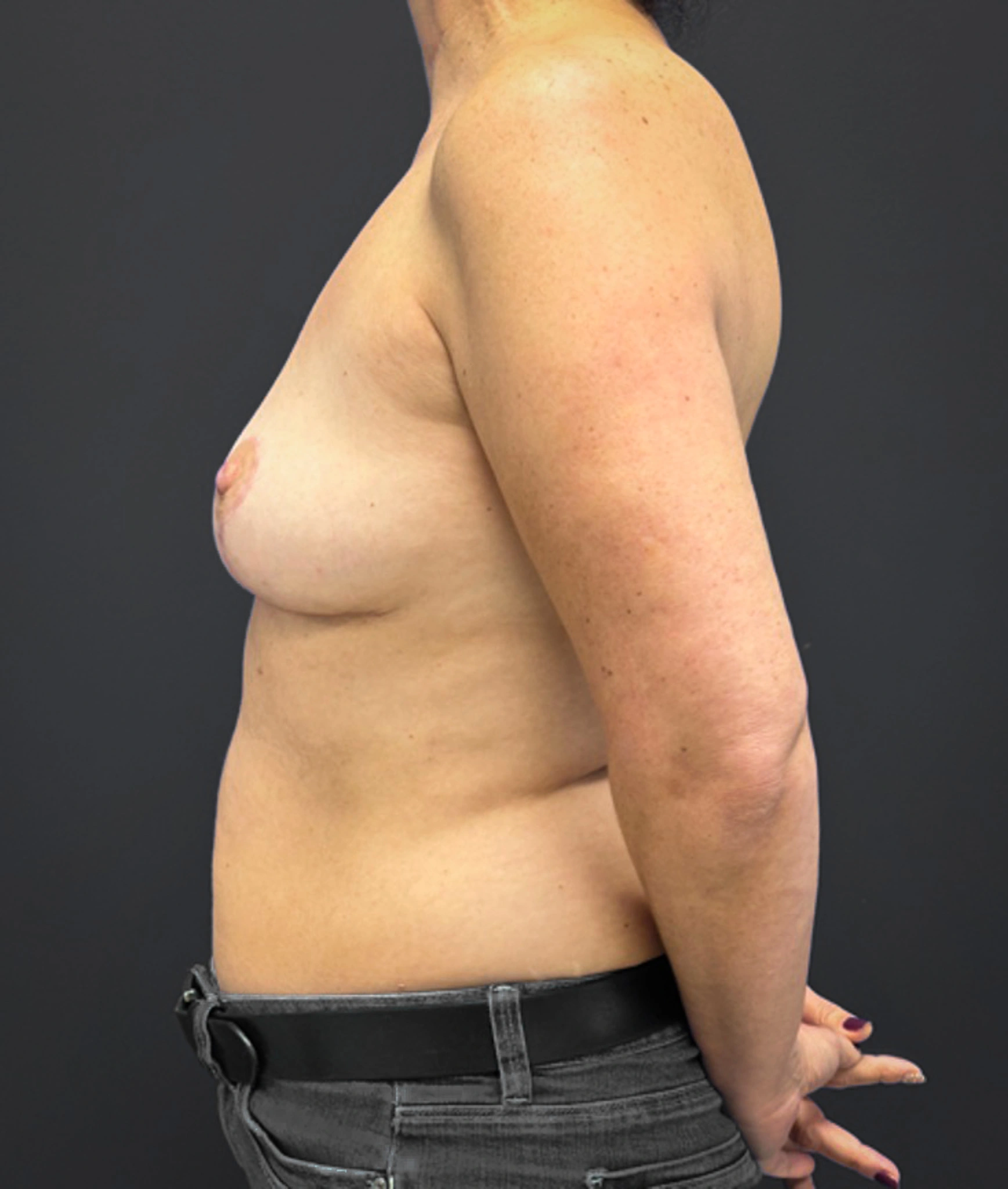 Mastopexy-Case--1663 | After Breast 2