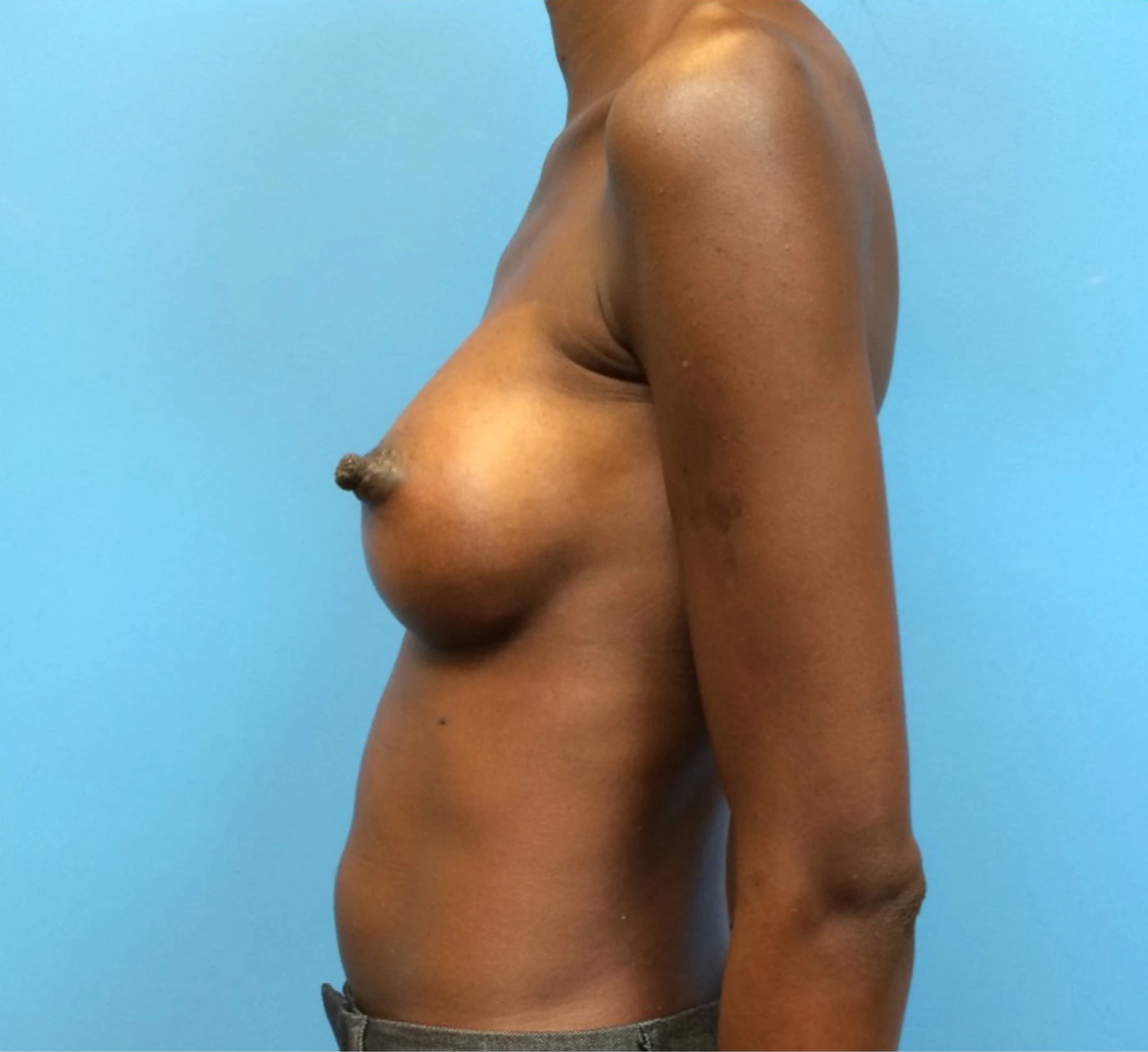 Case--97 | After Breast 2