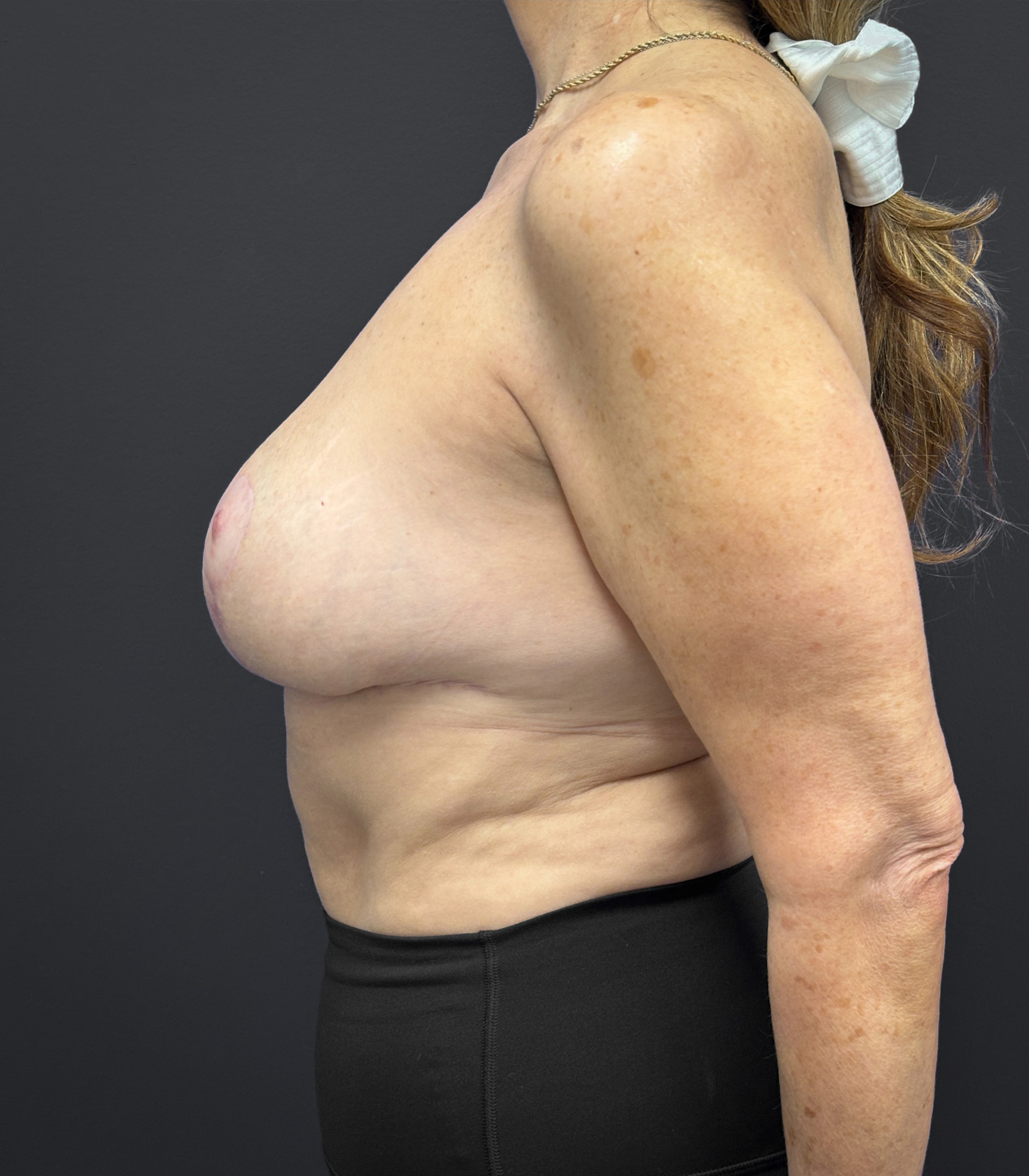 Breast-Reduction-Case--2538 | After Breast 2