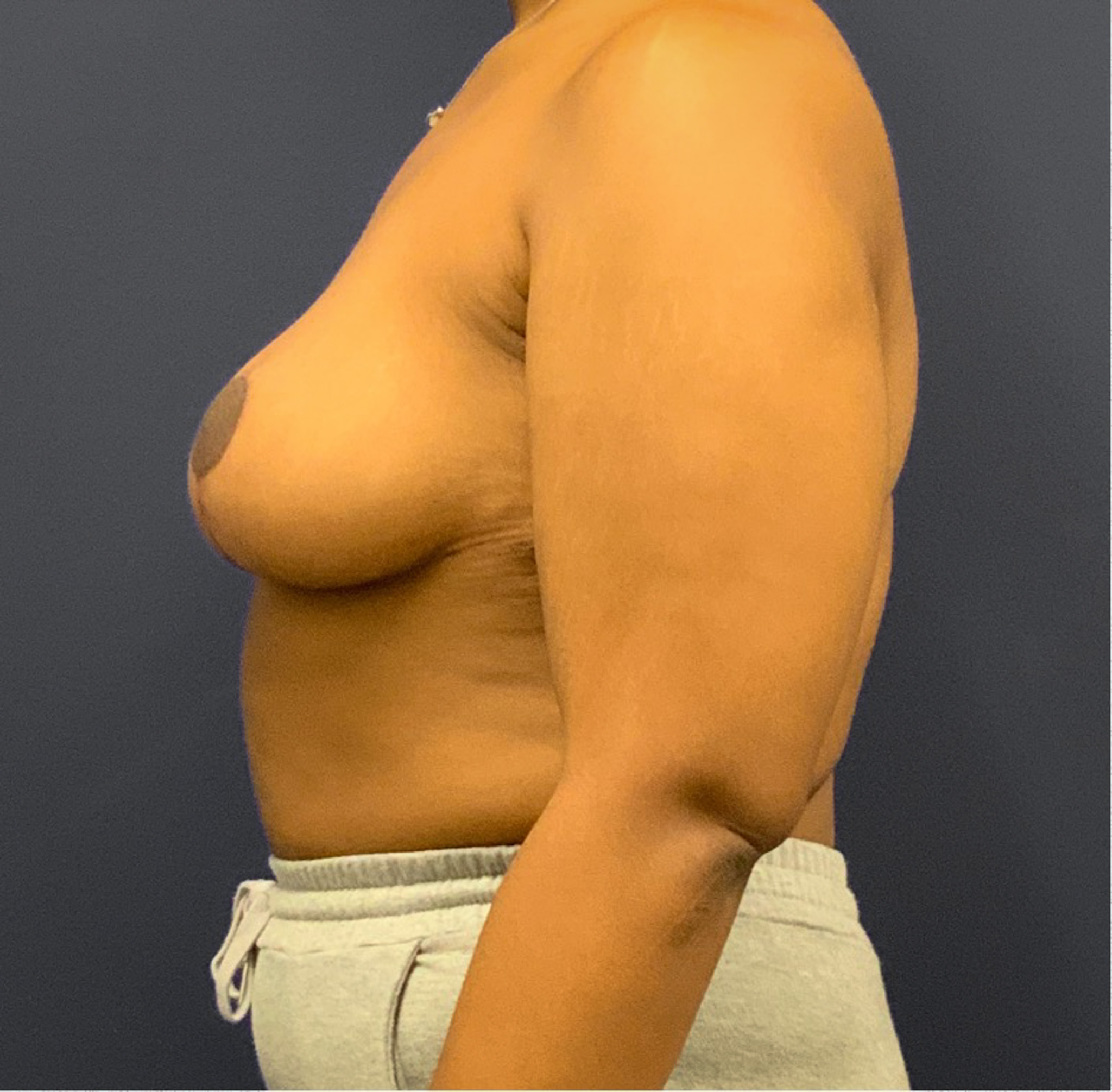 Breast-Reduction-Case--5320 | After Breast 2