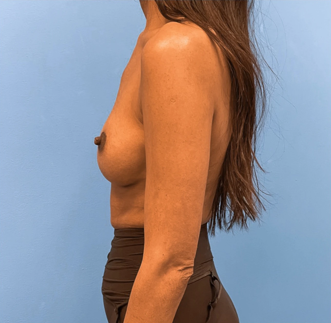Breast-Augmentation-Case--25592 | After Breast 2
