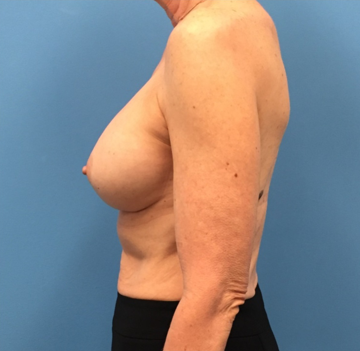 Revision-Breast-Augmentation-Case--237 | After Breast 2