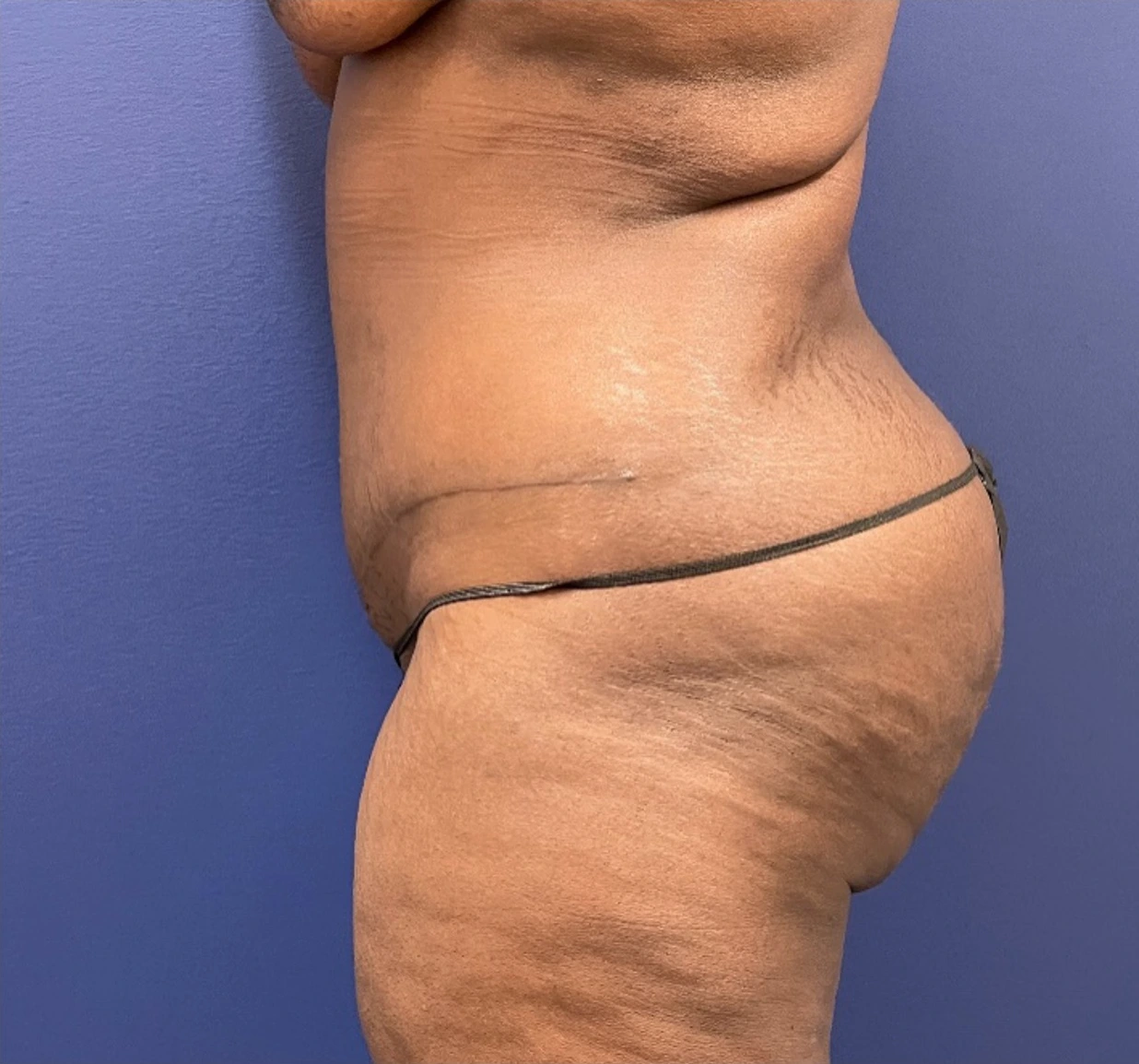 Case--257 | After Tummy Tuck 2