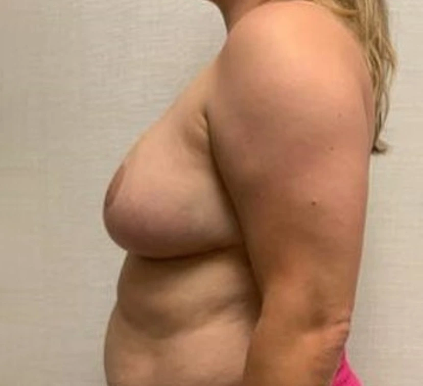 Breast-Reconstruction-Case--26525 | After Breast 2