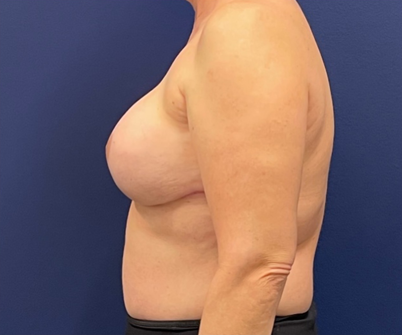Breast-Reconstruction-Case--308 | After Breast 2