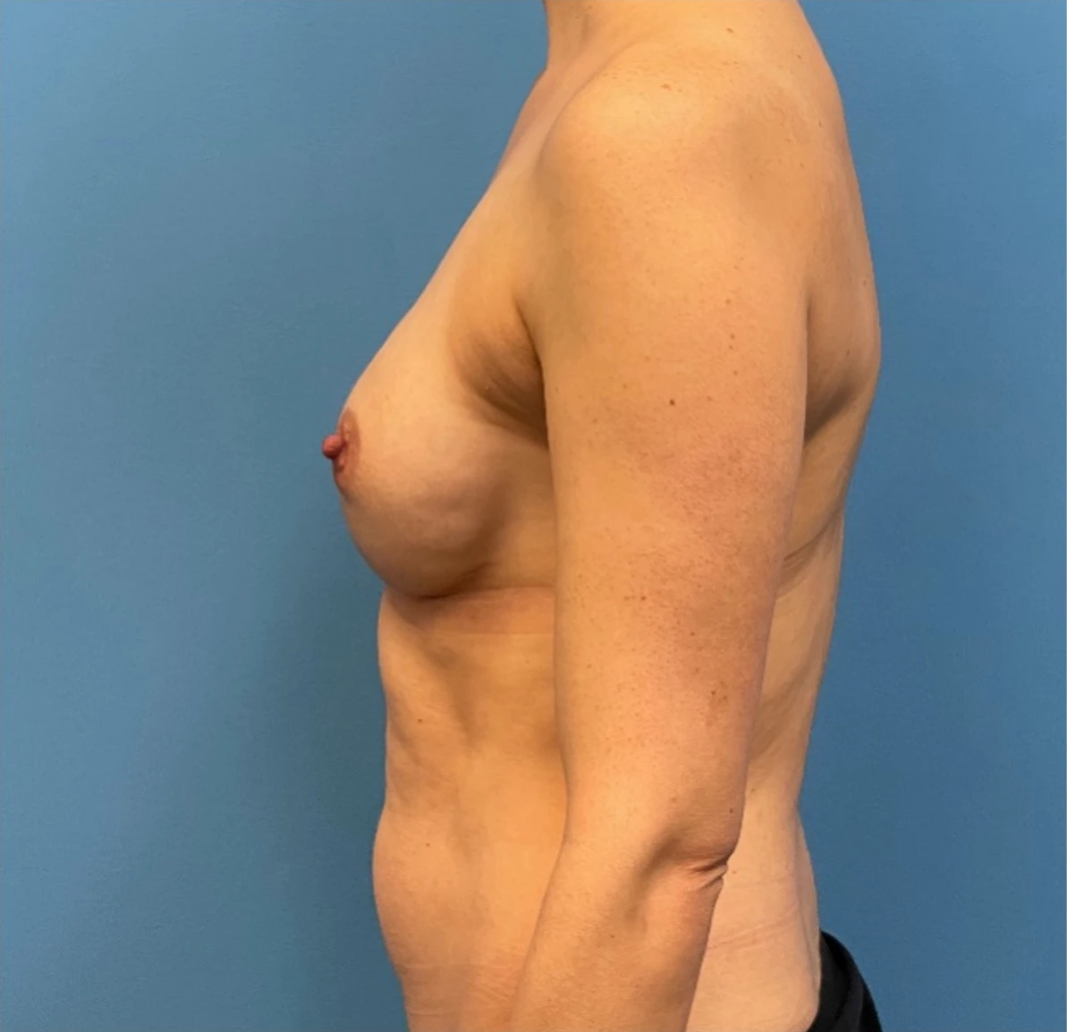 Breast-Reconstruction-Case--25209 | After Breast 2