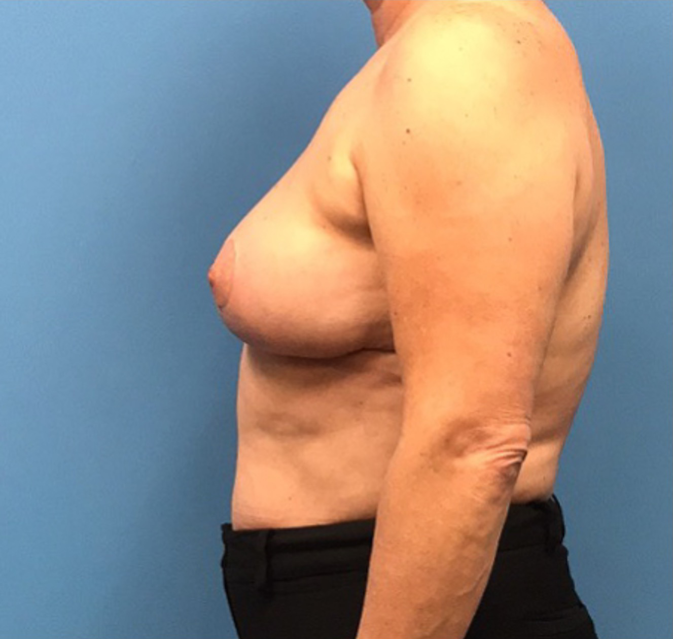 Case--314 | After Breast 2