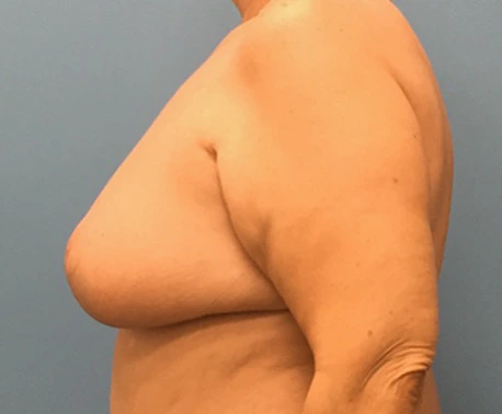 Breast-Reduction-Case--130 | After Breast 2