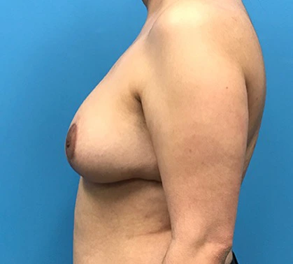 Breast-Reduction-Case--132 | After Breast 2