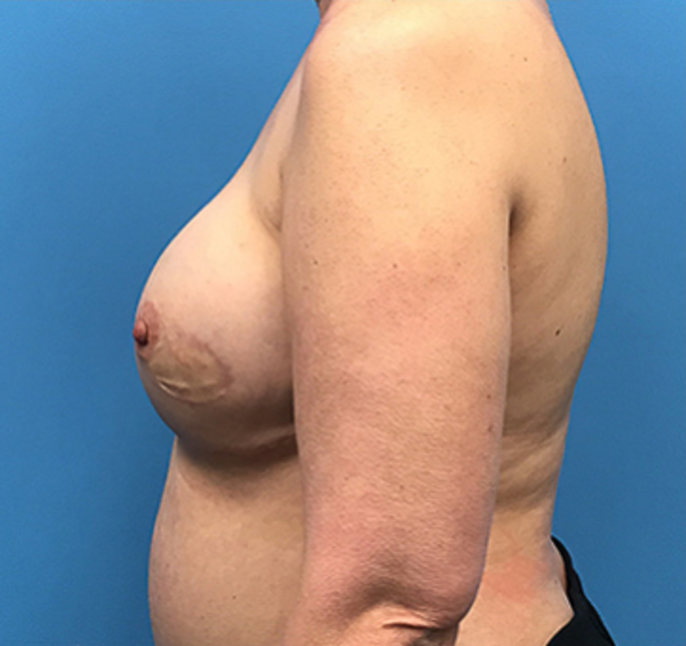 Case--136 | After Breast 2