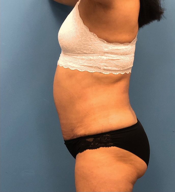 Case--14819 | After Tummy Tuck 2