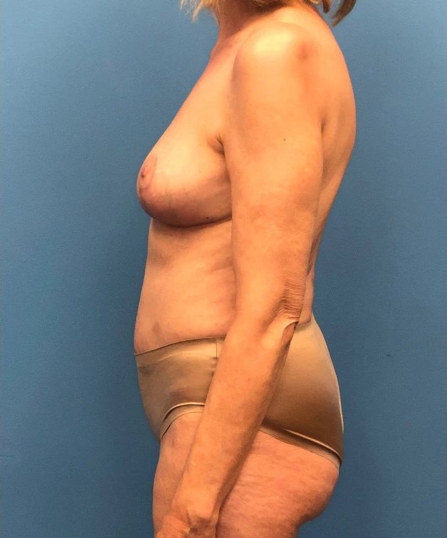 Case--17297 | After Breast 2