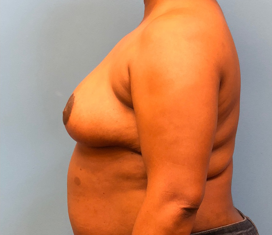Breast-Reduction-Case--12894 | After Breast 2