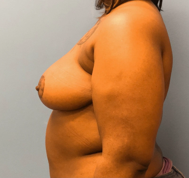 Breast-Reduction-Case--13002 | After Breast 2