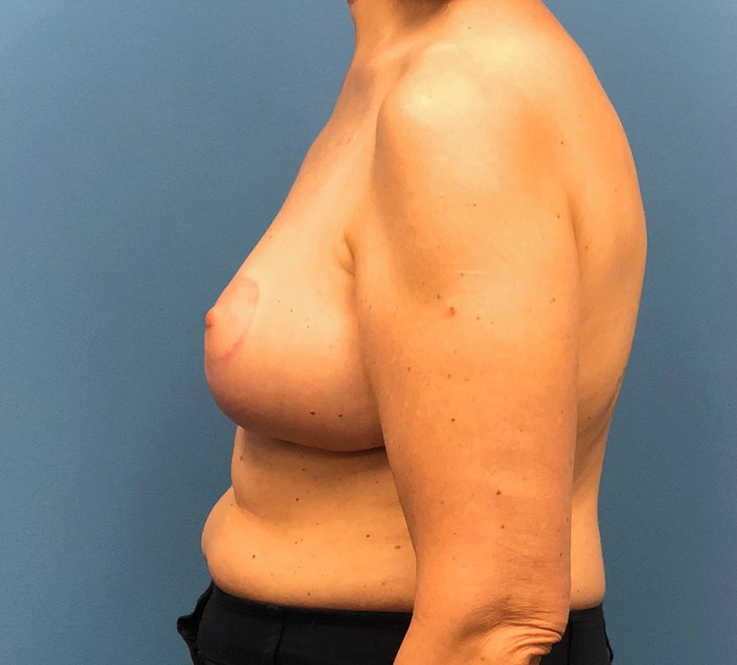 Breast-Reduction-Case--13180 | After Breast 2