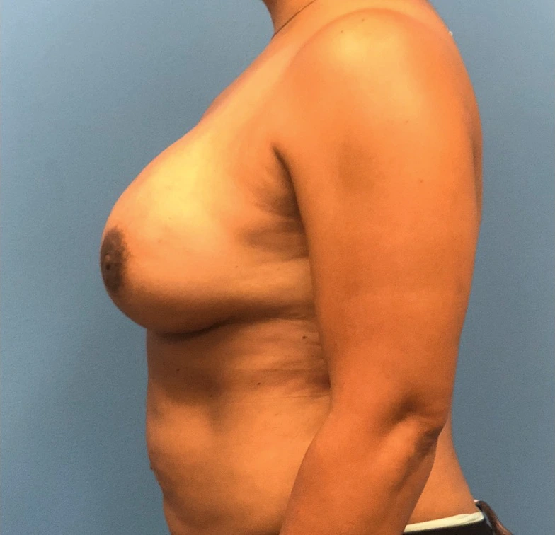 Case--11132 | After Breast 2