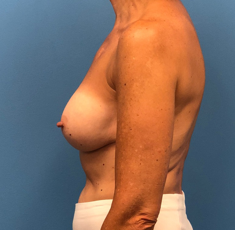 Revision-Augmentation--13287 | After Breast 2