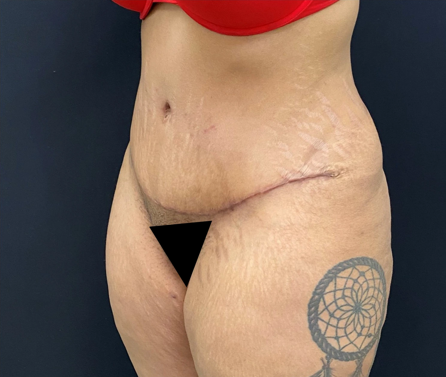 Liposuction-Tummy-Tuck-Case--338 | After Tummy Tuck 2