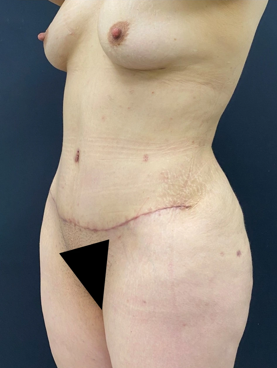 Lipoabdominoplasty-Case--339 | After Tummy Tuck 2