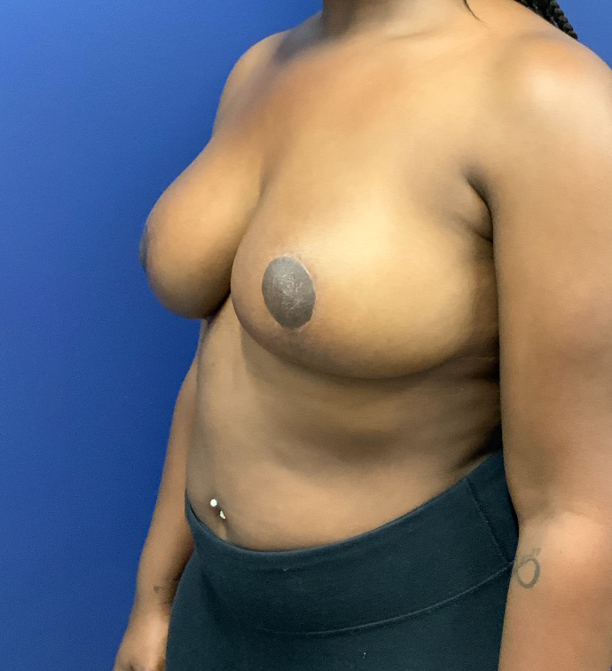 Breast-Reduction-Case--27530 | After Breast 2