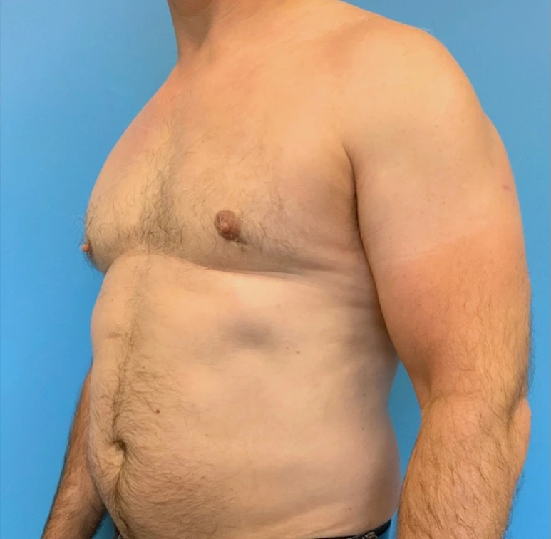 Gynecomastia-Case--20376 | After Breast 2